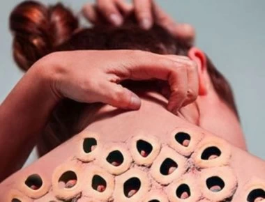 Τι είναι η τρυποφοβία - Ποιοι το έχουν